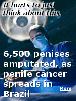 Between 2012 and 2022, there were 21,000 reported cases of penile cancer, according to Brazil's Ministry of Health. This resulted in more than 4,000 deaths and, over the past decade, there have been more than 6,500 amputations - averaging two each day. 